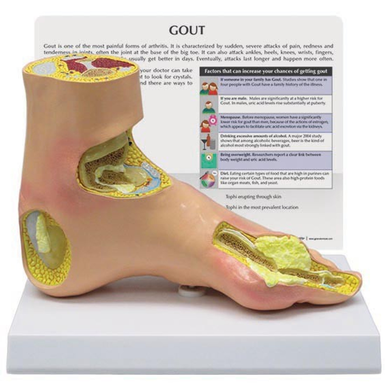 Gout Model Gout Patient Education Models GPI Anatomicals   1985 Gout Model Foot  63081.1637944480 