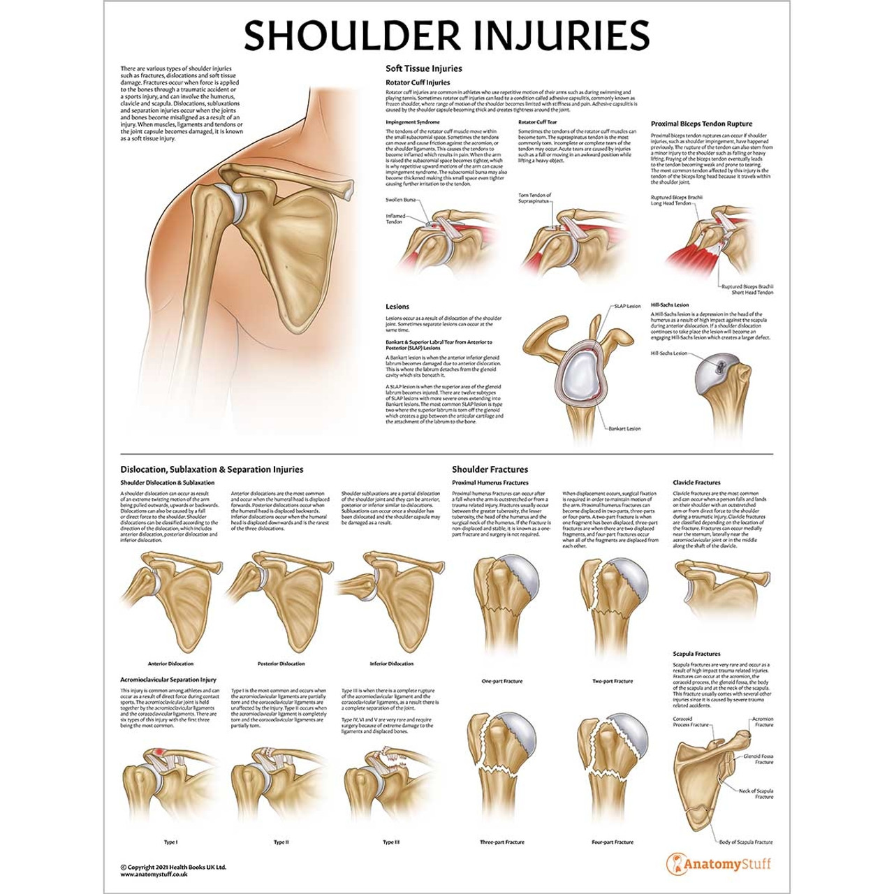 Shoulder Injuries Poster Upper Limb Injury Chart Dislocation Fracture