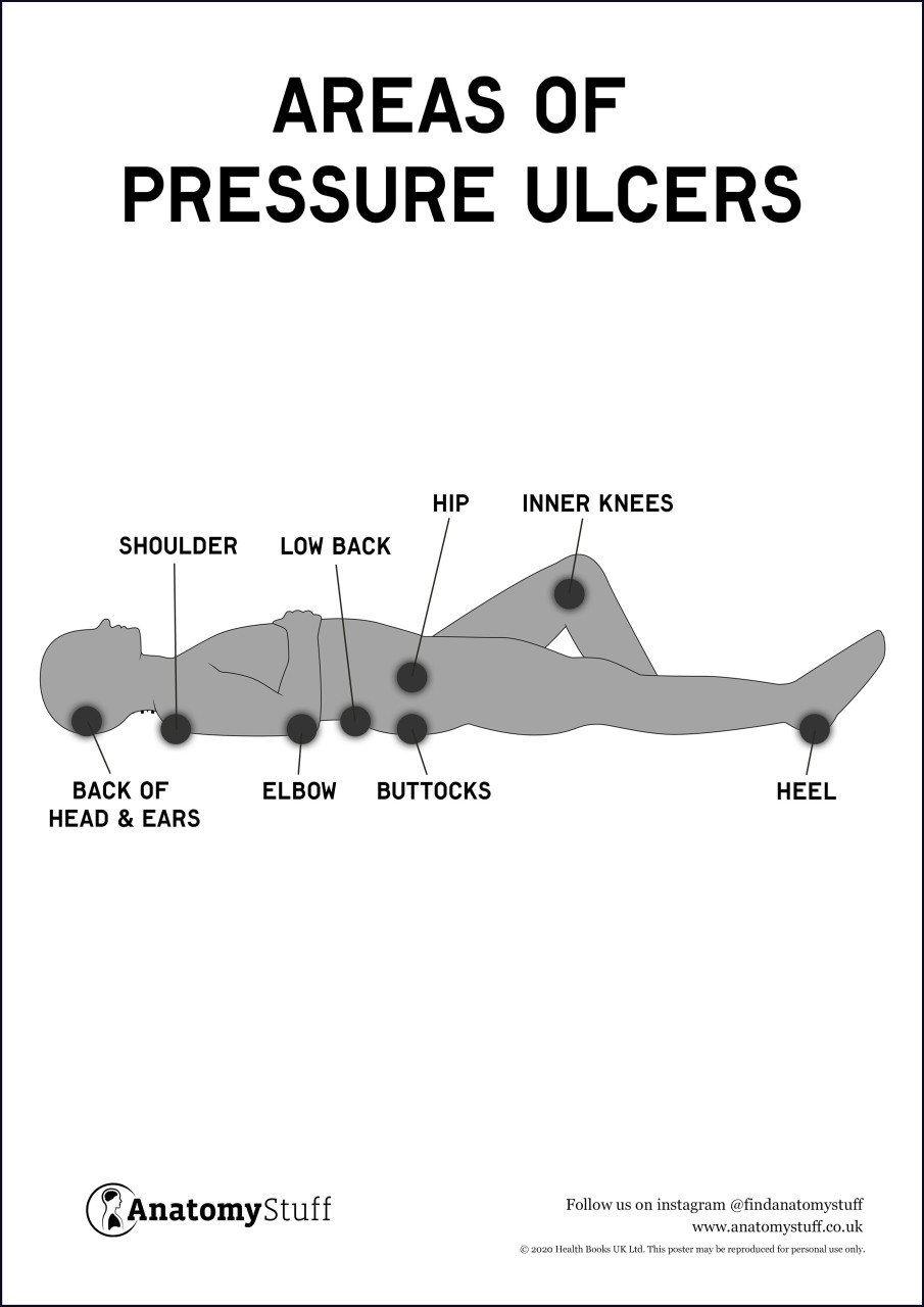 Pressure Ulcer Management Made Easy Pathway Any alteration in wound  characteristics may indicate a change in status and as such,