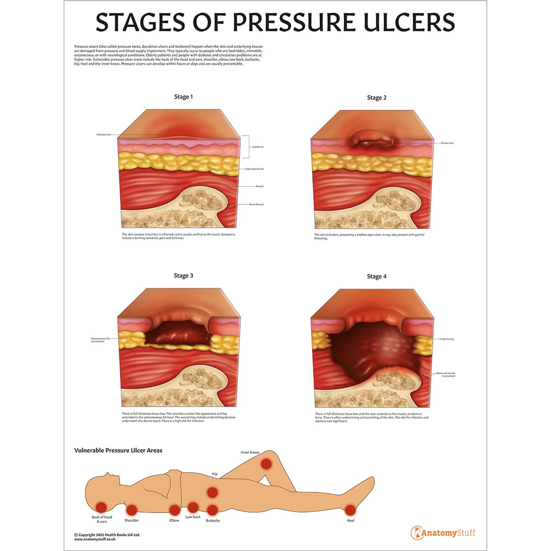 Stages Of Pressure Ulcers Chart Bedsore Decubitus Poster