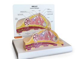 Benign Breast Disease Chart 9781587796746