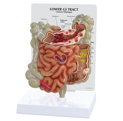 Cut-away model of the small and large intestines showing pathologies