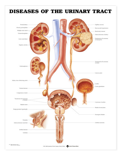 Diseases of the Urinary Tract Chart / Poster - Laminated