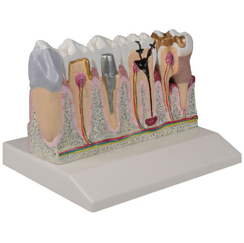 Tooth Disease Model (4 times life size) D250
