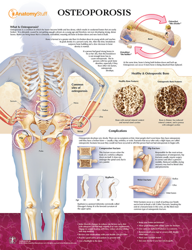 Laminated Osteoporosis Chart