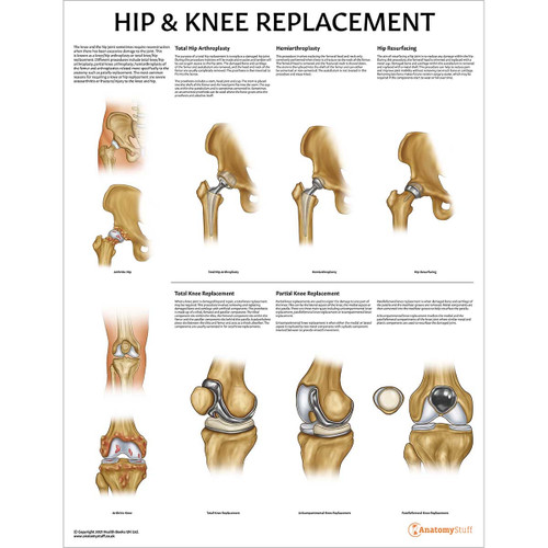 Hip & Knee Replacement Chart / Poster Laminated