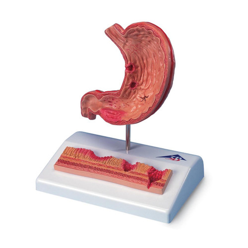 Stomach Model With Ulcers K17