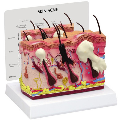 Normal / Acne Skin Model