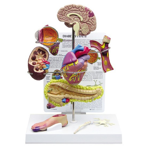 8 piece Type II Diabetes organ model