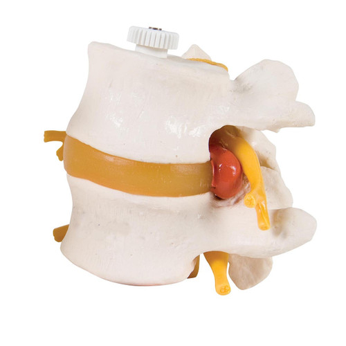 2 Lumbar Vertebrae Model with Prolapsed Disc (Flexibly Mounted) A76/9