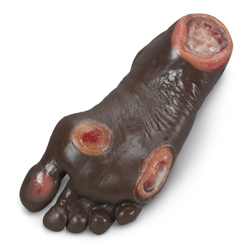 Elderly Pressure Ulcer Foot Model (Dark)