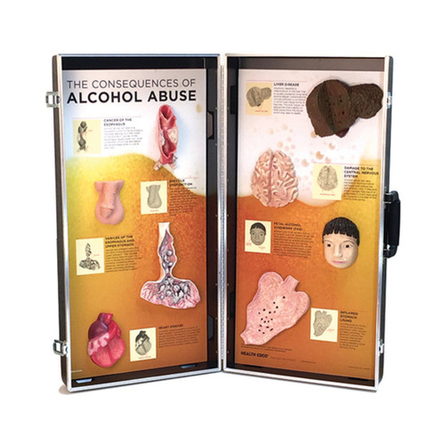 The Consequences of Alcohol Abuse 3D Display