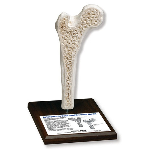 Osteoporosis Model