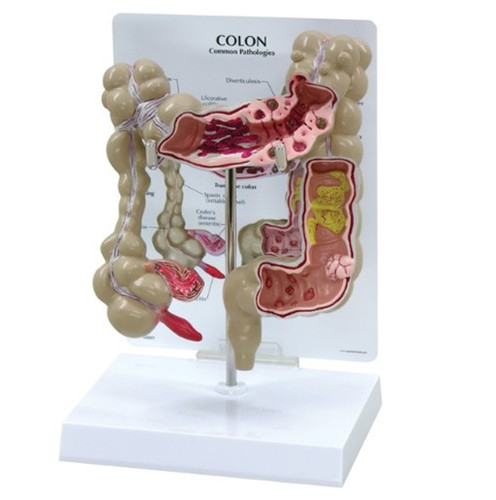 Cross-sectional Colon Model with 10 common pathologies