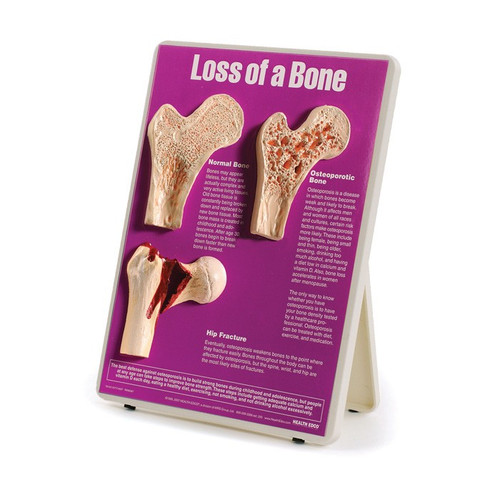 Loss of a Bone Easel Display