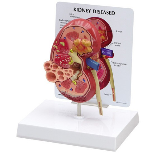 Double-sided Kidney Model showing a normal and diseased kidney