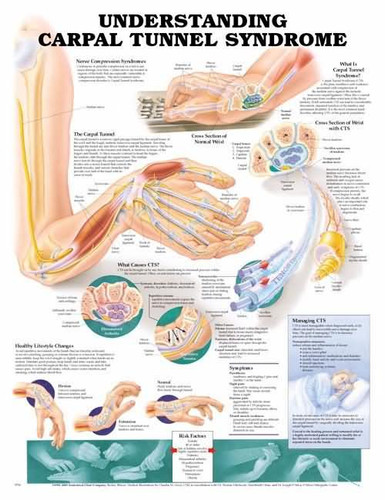 Understanding Carpal Tunnel Syndrome Chart / Poster - Laminated