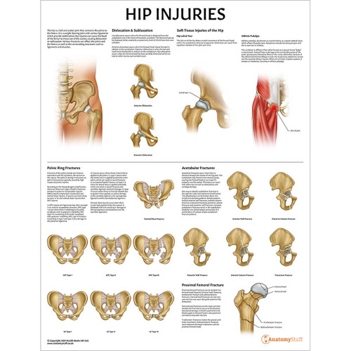 Laminated Hip Injuries Chart
