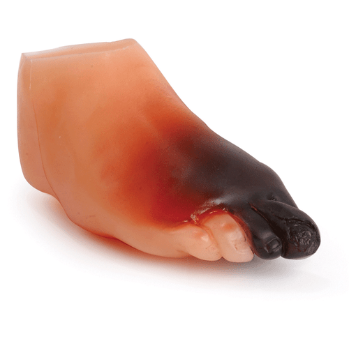 Severe Diabetic Foot Model