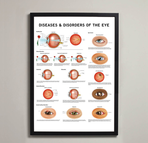 Framed Art Print of Eye Disorders
