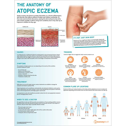 The Anatomy of Atopic Eczema Poster