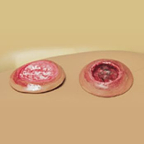 Set of 2 Decubitus Ulcers for Simple SIMON