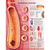 Atherosclerosis Poster / Chart Laminated