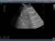 Pneumothorax and Thoracic Closed Drainage Ultrasound Image Sample