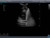 Pneumothorax and Thoracic Closed Drainage Ultrasound Image