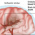 Illustrations of Areas of the Brain Affected by Stroke