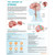 The Anatomy of Stroke Laminated Poster