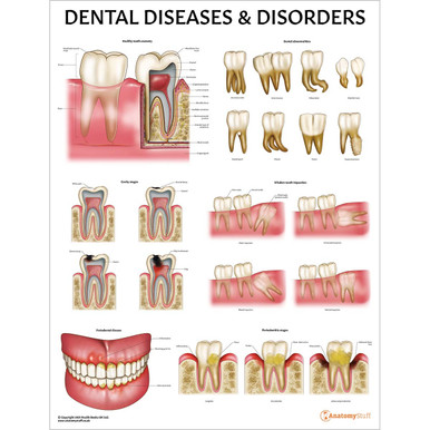 Dental Diseases & Disorders Chart / Poster - Laminated