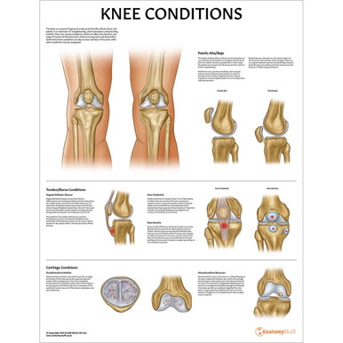 Knee Conditions Chart / Poster - Laminated