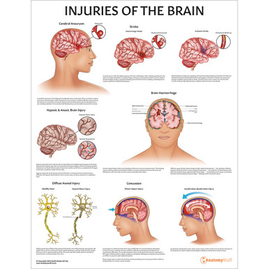 Injuries Of The Brain Chart / Poster - Laminated