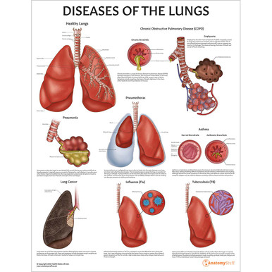 Diseases of the Lungs Chart / Poster - Laminated