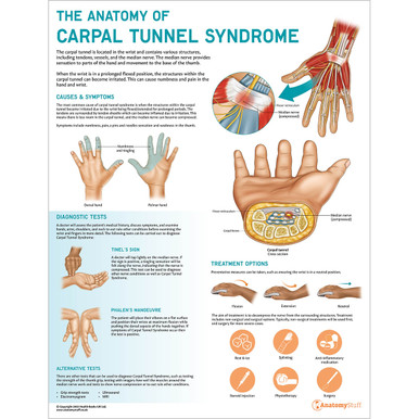 The Anatomy of Carpal Tunnel Syndrome Chart / Poster - Laminated