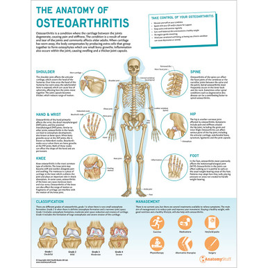 The Anatomy of Osteoarthritis Chart / Poster - Laminated