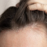Can You Get a Keratin Treatment If You Have Dandruff or a Sensitive Scalp?