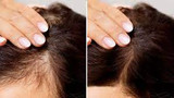 3 HAIR LOSS TREATMENTS FOR WOMEN & FOR MEN THAT WORK