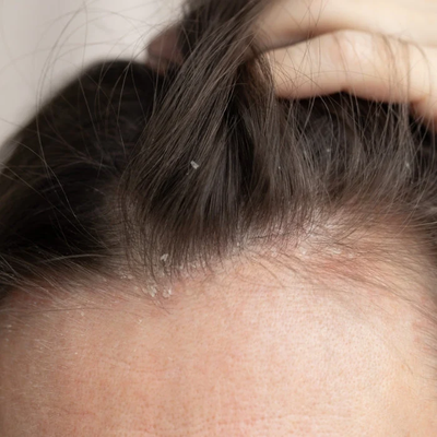 Can You Get a Keratin Treatment If You Have Dandruff or a Sensitive Scalp?