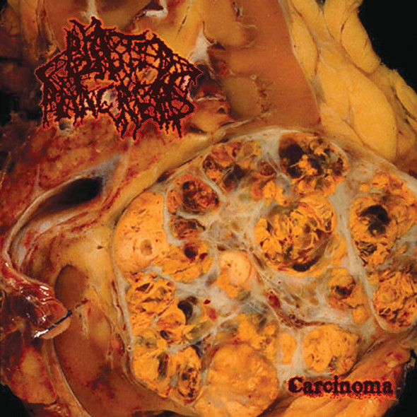 CARCINOMA
