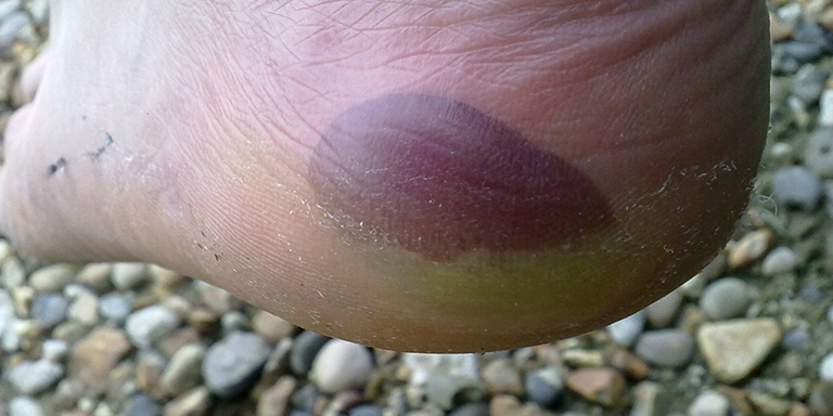Blood Blisters
