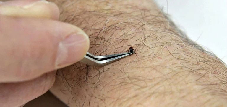 How To Remove A Tick