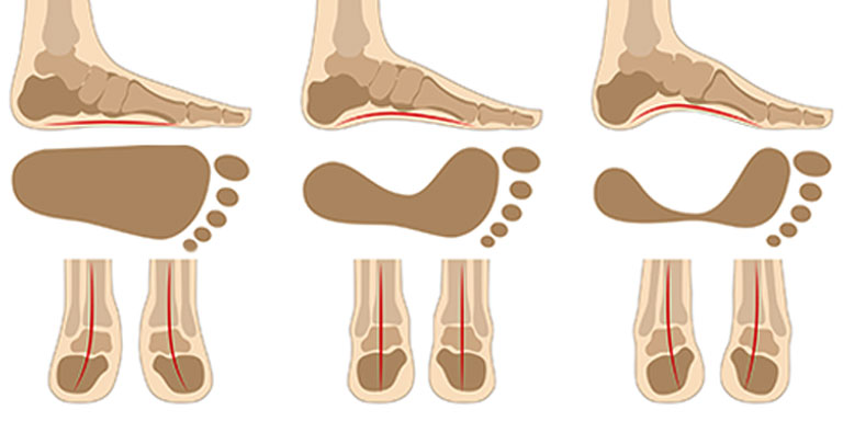 Assessing Your Foot Type