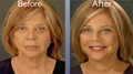 Art Harding Instant Facelift Kit