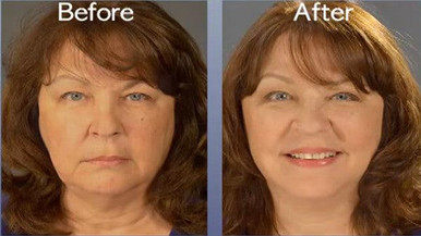 Art Harding Instant Facelift Kit