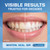 Plus White Teeth Whitening Kit, Tooth Whitening Gel & Mouth Tray (2 oz)