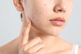 What Is Period Acne? Causes, Triggers, and What to Know