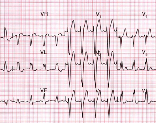 EKG EKG