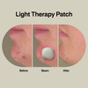 Acne Light Therapy Patch Kit 1/EA